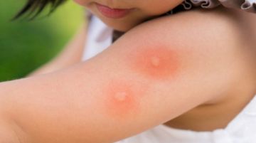Tại sao vết muỗi cắn gây ngứa và cách trị vết ngứa muỗi cắn
