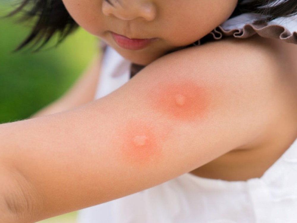 Vết cắn muỗi đốt gây ra sự khó chịu cho bé