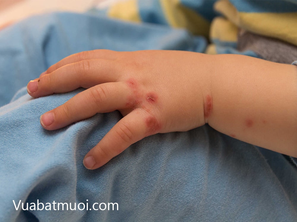 Cảnh giác với các vết muỗi đốt trên người bé