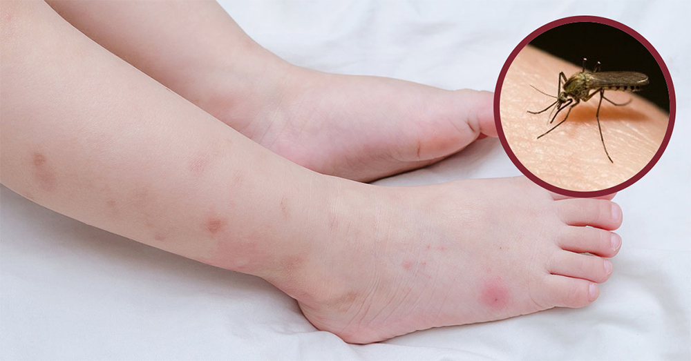 Muỗi đốt không chỉ làm tổn thương da mà còn làm tăng nguy cơ lây các bệnh cho con người