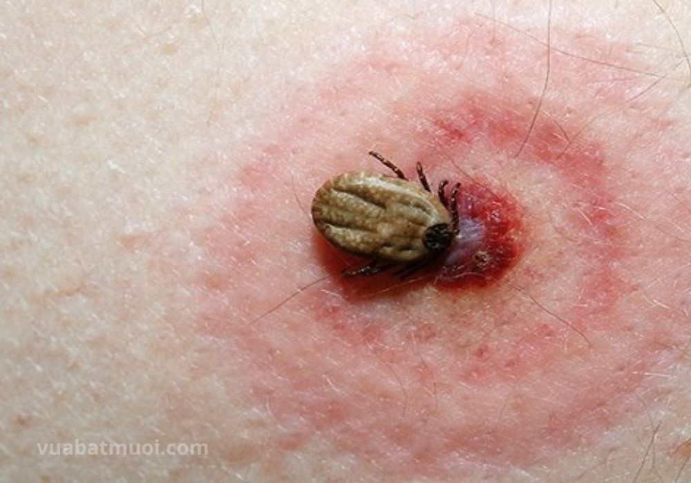 Bệnh truyền nhiễm do côn trùng - Bọ ve