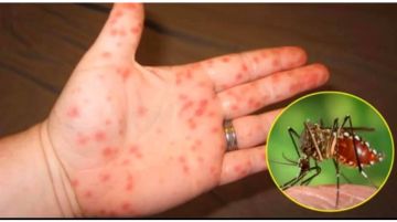 Bị muỗi đốt bao nhiêu ngày thì sẽ bị bệnh sốt xuất huyết? Cách phòng bệnh sốt xuất huyết