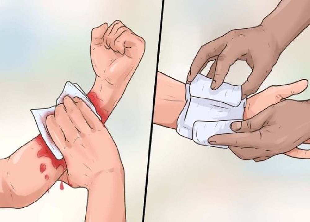 Cần lưu ý gì trước nguy cơ bị đông máu trong sốt xuất huyết