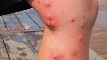 Cách ngăn ngừa điều trị côn trùng đốt ở trẻ nhà – Làm cách nào điều trị vết côn trùng cắn
