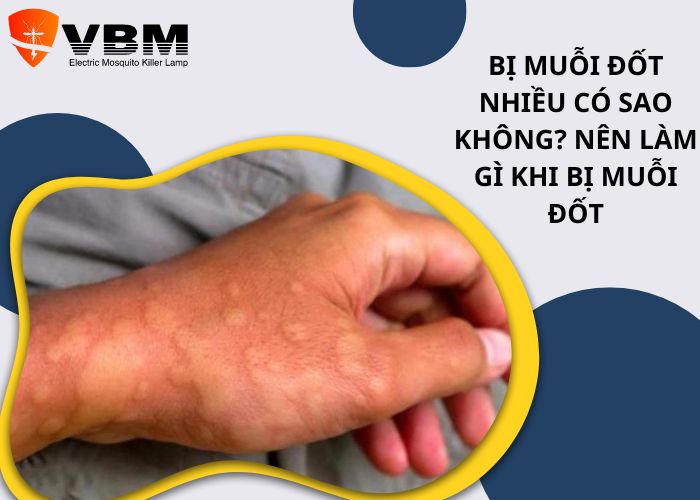 Bị muỗi đốt nhiều có sao không? Nên làm gì khi bị muỗi đốt